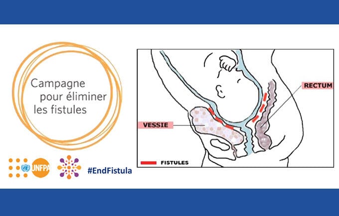 La fistule obstétricale se guérit